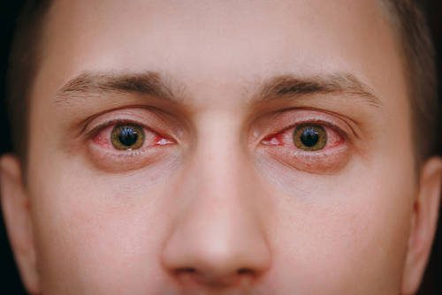 Eye Bleeding Virus Reaches Europe