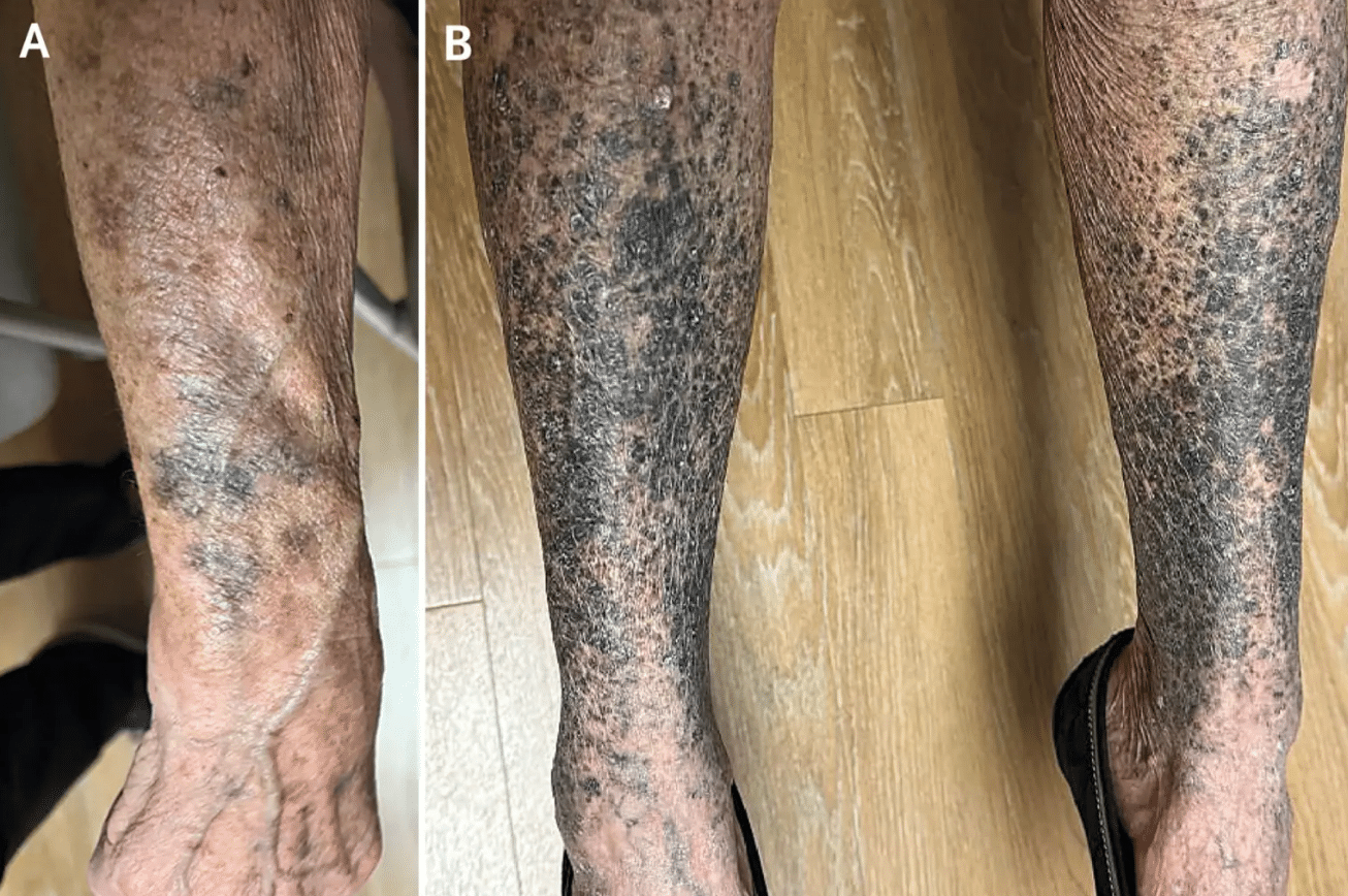 Woman's Skin Turns Blue-Gray After Taking Common Antibiotic